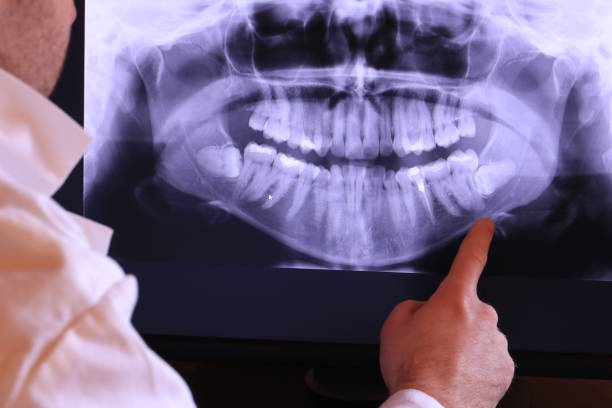 Best Knocked-Out Tooth (Avulsed Tooth) Treatment in Coker, AL
