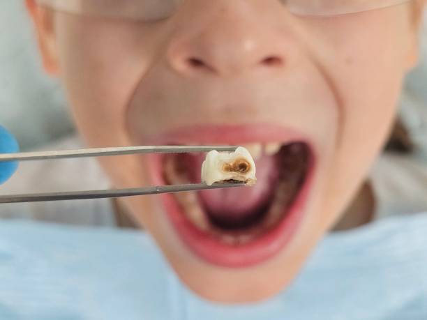 Best Emergency Treatment for Oral Infections in Coker, AL